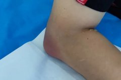 如何避免痛风反复发作？做好8件事改变生活！