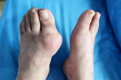 当痛风急性发作，运动可以减轻关节的疼痛？