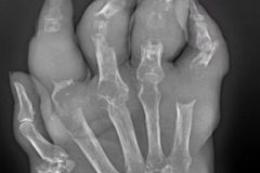 痛风石长满双手，它如何破坏我们的关节？