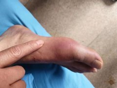 吃药引起的尿酸升高怎么办？你要知道这两点