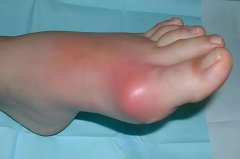 痛风急性发作时，6件事让关节加倍痛，千万别做！